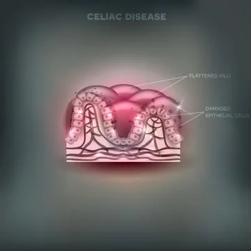 Celiac disease Stock Illustration