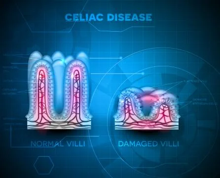 Celiac disease Stock Illustration