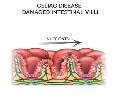 Celiac disease Stock Illustration