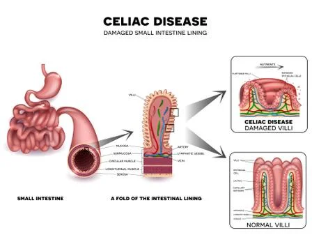 Celiac disease Stock Illustration