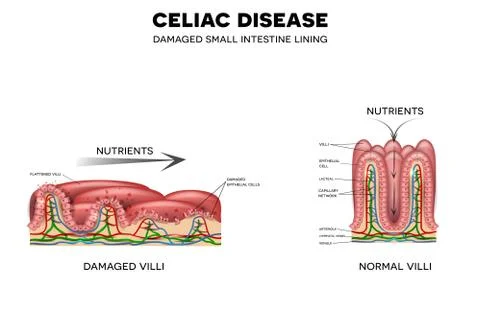 Celiac disease Illustrazione stock