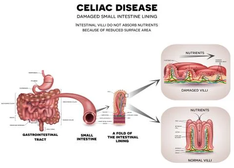 Celiac disease Stock Illustration