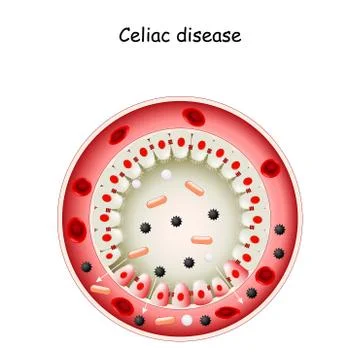 Celiac disease. Stock Illustration