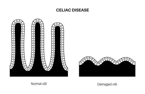 Celiac disease inflammation Illustrazione stock