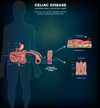 Celiac disease info poster Stock Illustration