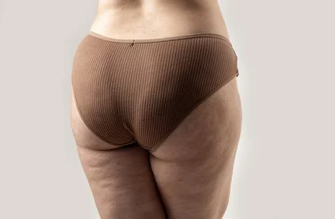 Cellulite on thigh with circulation and subcutaneous structure. Healthcare .. Stock Photos