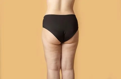 Cellulite thigh problem skin. Cellulite thigh fat skin texture. Woman with ce Stock Photos
