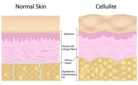 Cellulite versus smooth skin Stock Illustration