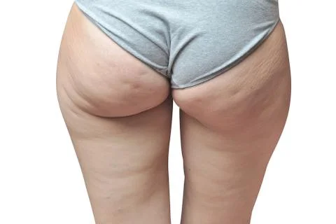 Cellulite at woman buttocks isolated on white 库存照片