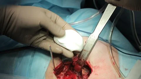 Cement For Hip Surgery Stockfoto's