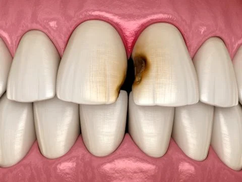 Central incisor teeth damaged by caries. Medically accurate tooth 3D illustra Illustrazione stock