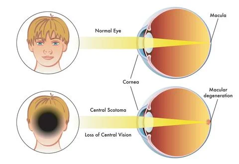 Central scotoma Stock Illustration