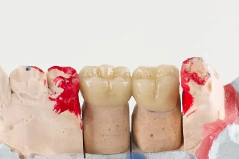 Ceramic crowns to try on a tooth model Stock Photos