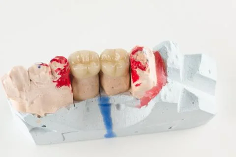 Ceramic crowns to try on a tooth model Stock Photos