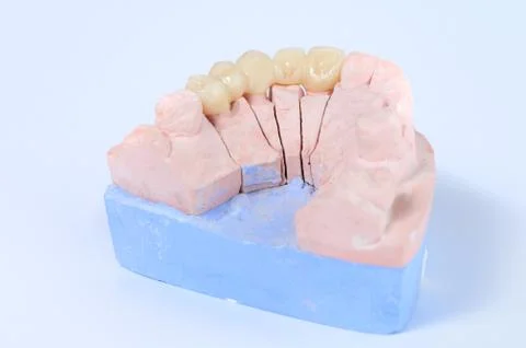 Ceramic tooth crown on plaster model Stock Photos