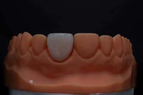 Ceramic veneer with transparent edge on a upper jaw model on a black backgrou Stock Photos
