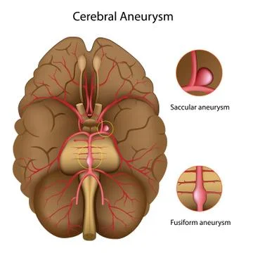 Cerebral aneurysm Stock Illustration
