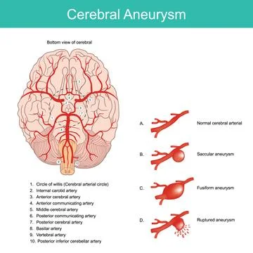 Cerebral Aneurysm. Stock Illustration