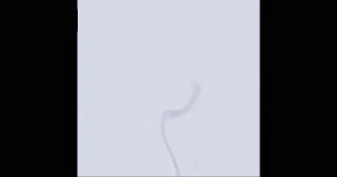 Cerebral angiogram. Stock Footage 206992292