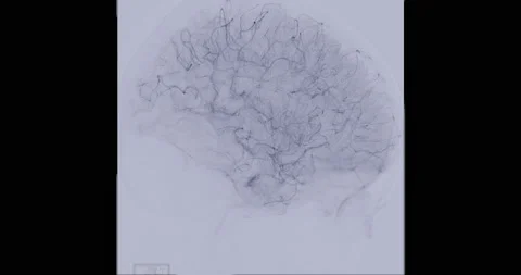 Cerebral angiogram. Stock Footage 206992996