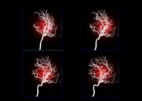 Cerebral angiography  3D . Stock Illustration