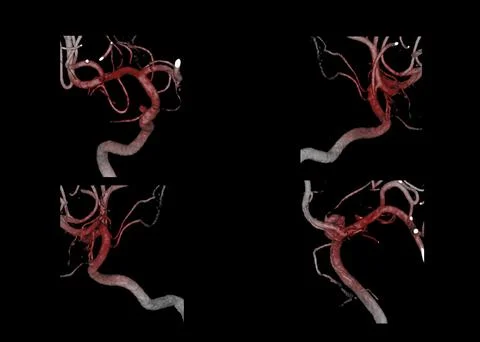 Cerebral angiography  3D . Stock-Illustration