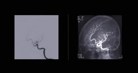 Cerebral angiography Stock Footage 194892000