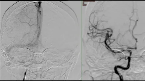 Cerebral angiography Stock Footage 217862904