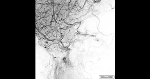 Cerebral angiography Stock Footage 292466187
