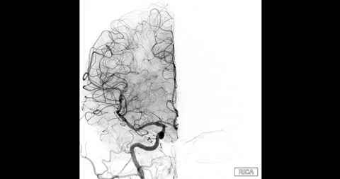 Cerebral angiography Stock Footage 292466237