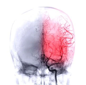 Cerebral angiography Stock Illustration