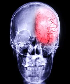 Cerebral angiography Stock Illustration