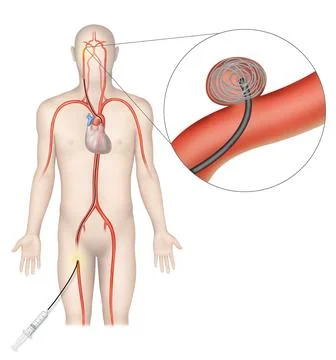 Cerebral angiography Stock Illustration