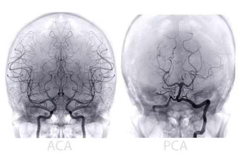 Cerebral angiography  image from Fluoroscopy in intervention radiology  sho.. Stock Illustration