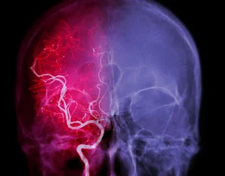 Cerebral angiography  image from Fluoroscopy in intervention radiology  sho.. Stock Illustration
