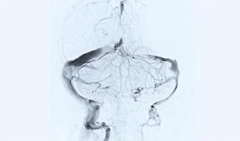 Cerebral angiography  image from Fluoroscopy in intervention radiology  sho.. Illustrazione stock