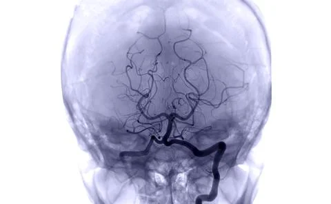 Cerebral angiography  image . Stock Illustration