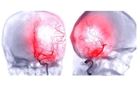 Cerebral angiography  image . 스톡 일러스트