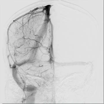 Cerebral angiography is a specialized procedure to visualize the arteries a.. Stock-Illustration