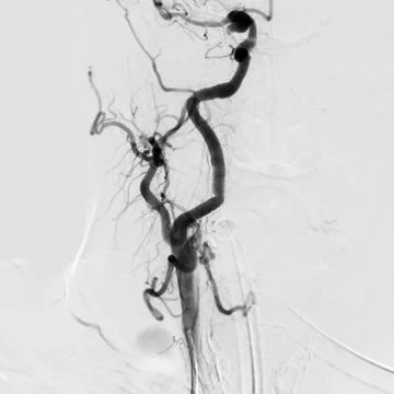 Cerebral angiography is a specialized procedure to visualize the arteries a.. Stock Illustration
