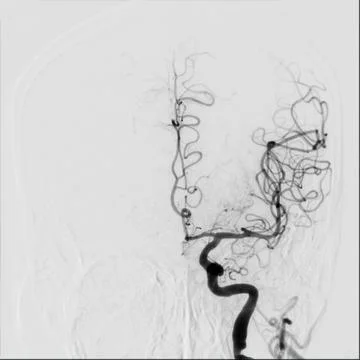 Cerebral angiography is a specialized procedure to visualize the arteries a.. Stock Illustration