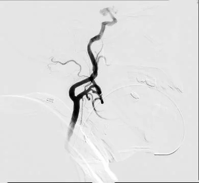 Cerebral angiography is a specialized procedure to visualize the arteries a.. Stock Illustration