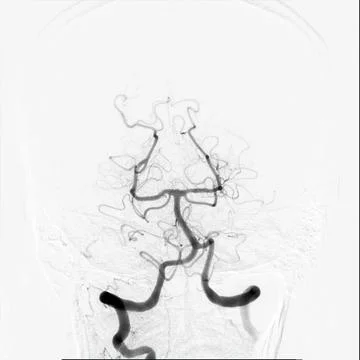 Cerebral angiography is a specialized procedure to visualize the arteries a.. Stock Illustration