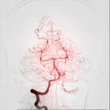 Cerebral angiography is a specialized procedure to visualize the arteries a.. Stock-Illustration