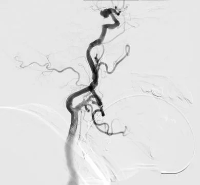 Cerebral angiography is a specialized procedure to visualize the arteries a.. Illustrazione stock