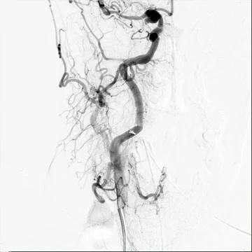 Cerebral angiography is a specialized procedure to visualize the arteries a.. Stock Illustration
