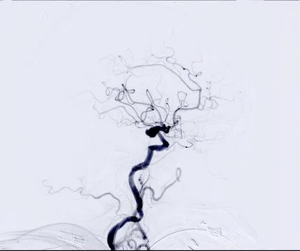 Cerebral angiography is a specialized procedure to visualize the arteries a.. Stock Illustration
