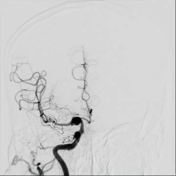 Cerebral angiography is a specialized procedure to visualize the arteries a.. Stock Illustration