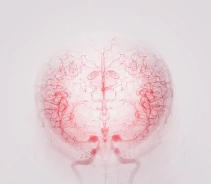 Cerebral angiography is a specialized procedure to visualize the arteries a.. Stock Illustration