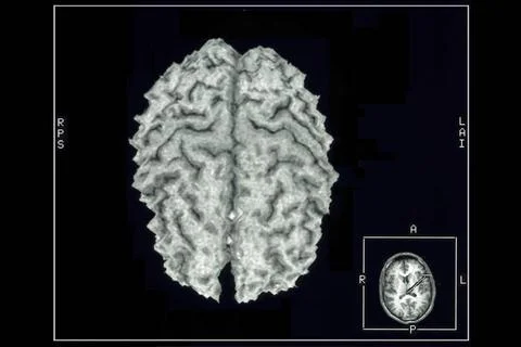  Cerebral cortex, mri Normal cerebral cortex. Computer-generated 3D image.... Stock Photos
